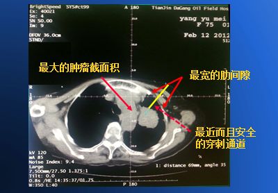 3D打印“引路”放射性粒子精準(zhǔn)殺傷腫瘤