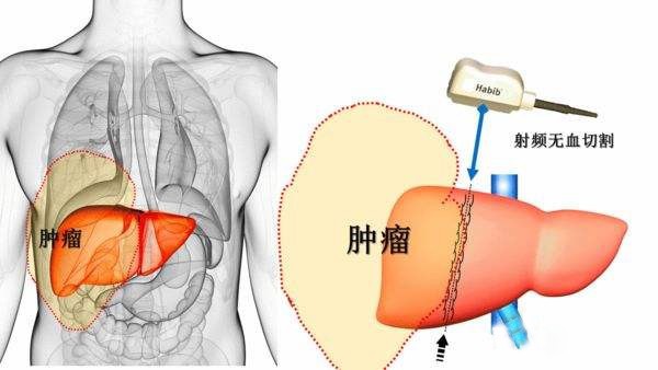 放射性粒子治療腫瘤，3D打印技術(shù)可望減少“多余”劑量