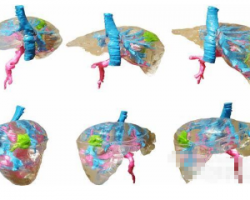 波蘭創(chuàng)建低成本彩色肝臟3D打印模型